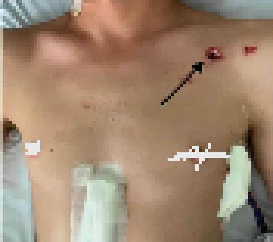 [e97869] Two Gore+- its a gun shot wound, a friend sent me this.